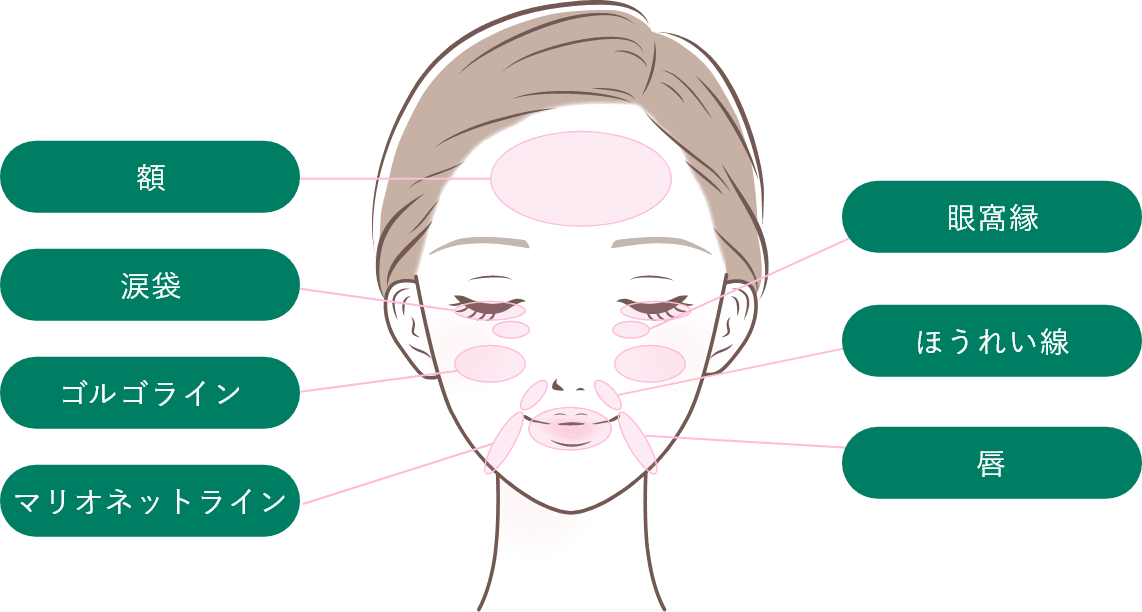 ヒアルロン酸注射の対応部位