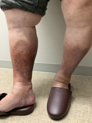 下肢静脈瘤の検査方法を知ろう 1 下肢静脈瘤の検査方法を知ろう