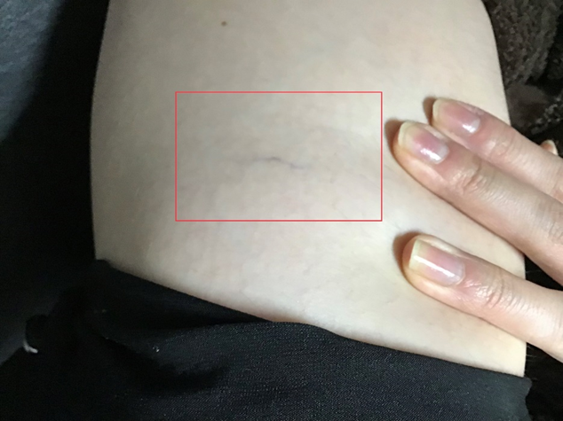 【網の目・くもの巣静脈瘤の治療　YAG編 その1】