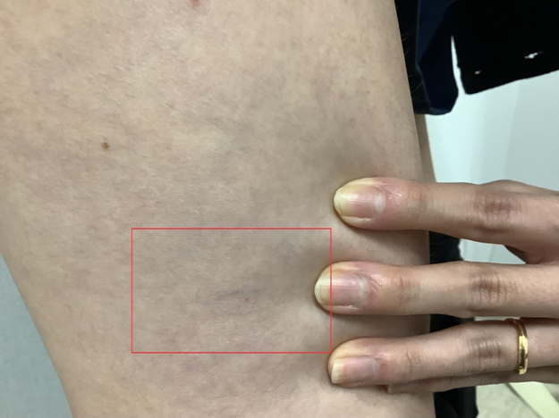 【網の目・くもの巣静脈瘤の治療　YAG編 その1】