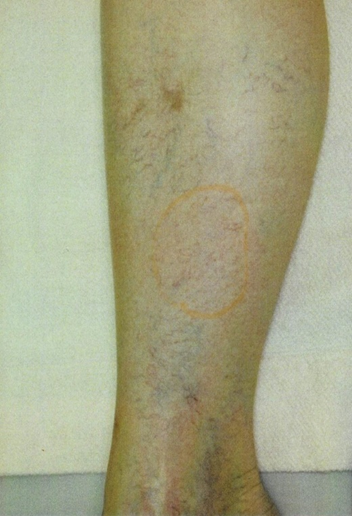 【網の目・くもの巣静脈瘤の治療 YAG編 その2】 1 【網の目・くもの巣静脈瘤の治療 YAG編 その2】