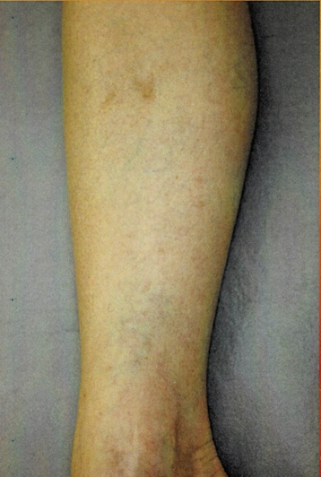 【網の目・くもの巣静脈瘤の治療 YAG編 その2】 2 【網の目・くもの巣静脈瘤の治療 YAG編 その2】