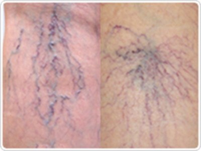 スパイダーベインとは?原因から治療方法まで詳しく解説