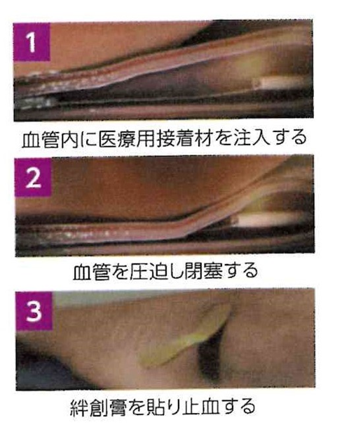 【医療用接着剤による血管内治療について】 1 【医療用接着剤による血管内治療について】