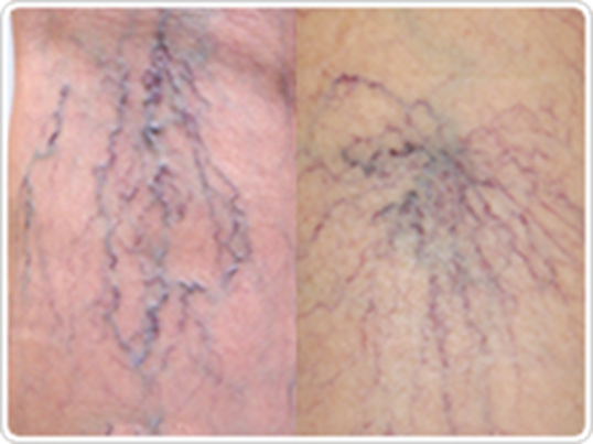 スパイダーベインとは？原因から治療方法まで詳しく解説