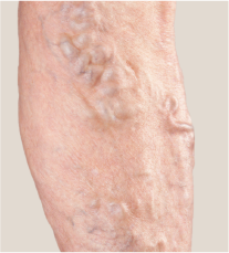 【小さなキズで脚のこぶをなくすには？】