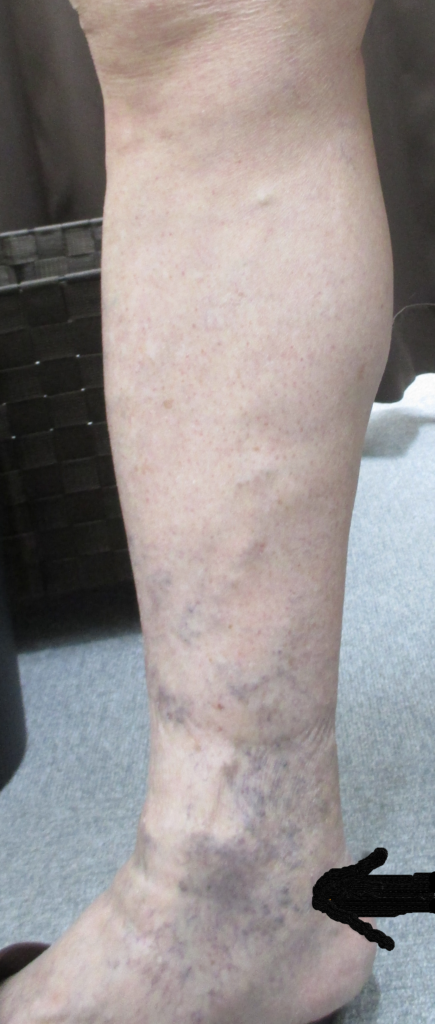 【Corona Phlebectaticaコロナ フレベクテイティカについて】 1 【Corona Phlebectaticaコロナ フレベクテイティカについて】