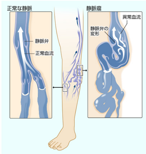 【美容師さん・理容師さんは下肢静脈瘤になりやすいって本当？】