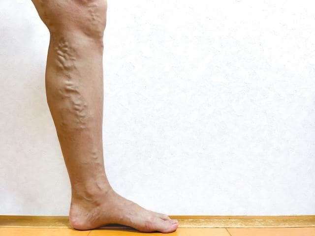 下肢静脈瘤の原因とは?予防方法も詳しく解説 1 下肢静脈瘤の原因とは?予防方法も詳しく解説