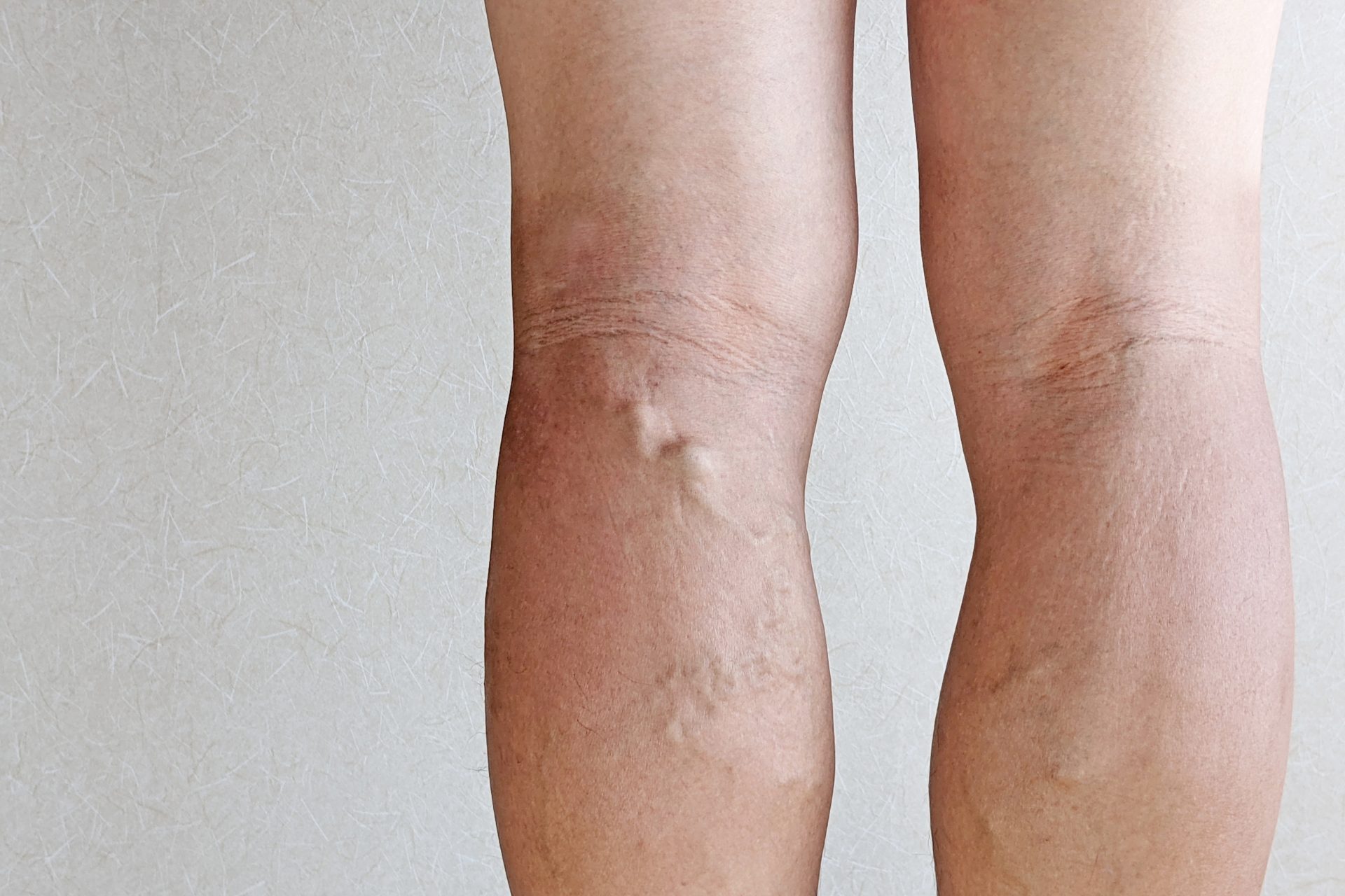 【足のむくみは何科に行けば良い？】