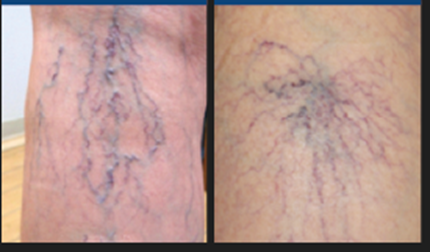 青い血管が目立つ原因は？足のふくらはぎや太腿に見える血管の原因から症例まで解説