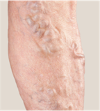 青い血管が目立つ原因は？足のふくらはぎや太腿に見える血管の原因から症例まで解説