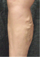 青い血管が目立つ原因は？足のふくらはぎや太腿に見える血管の原因から症例まで解説