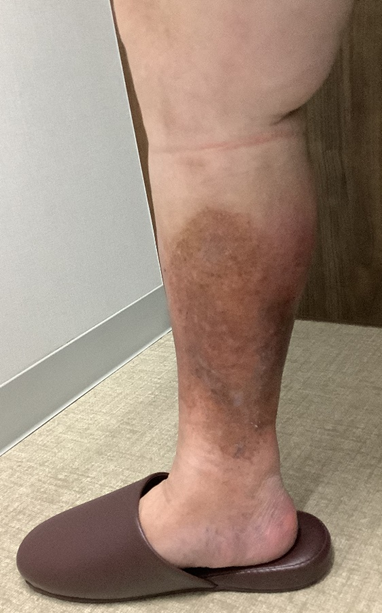 【下肢静脈瘤の初期症状について】 1 【下肢静脈瘤の初期症状について】