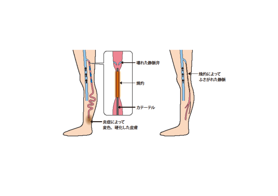【静脈瘤の治療紹介！　血管内焼灼術編・動画あり】