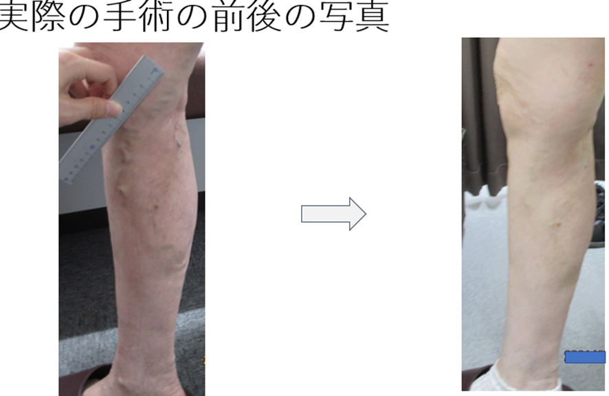 【静脈瘤の治療紹介！　血管内焼灼術編・動画あり】