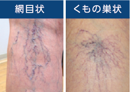 【静脈瘤の注射治療紹介！硬化療法とYAGレーザー治療について　動画あり】