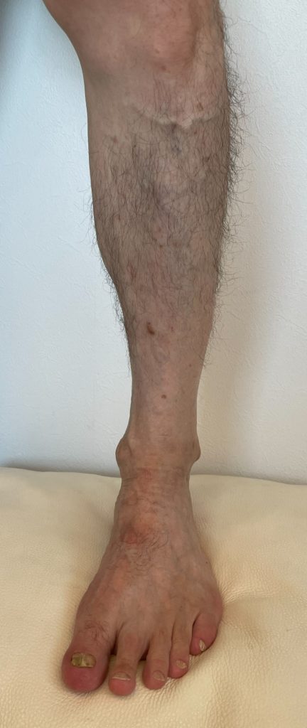 青い血管が目立つ原因は？足のふくらはぎや太腿に見える血管の原因から症例まで解説