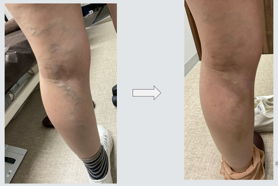 【静脈瘤の注射治療紹介！硬化療法とYAGレーザー治療について　動画あり】