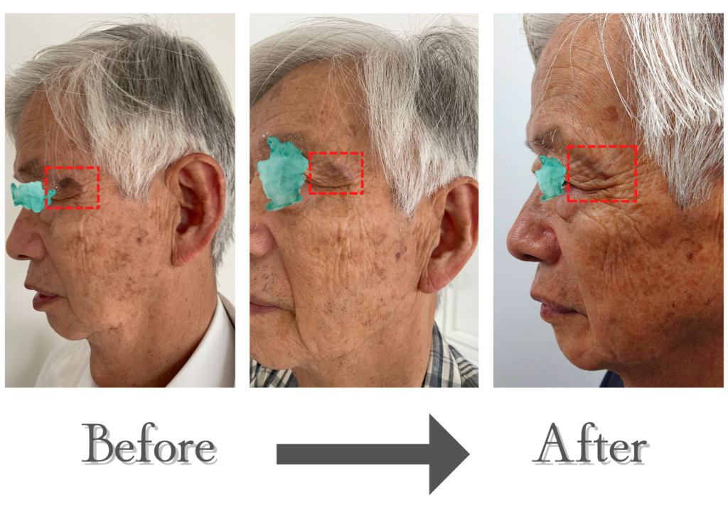 【シミ取り体験】