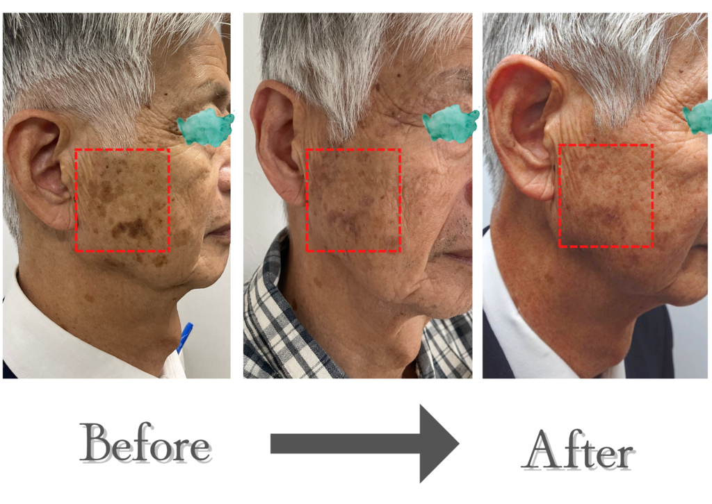 [シミ取りレーザー始めました！]