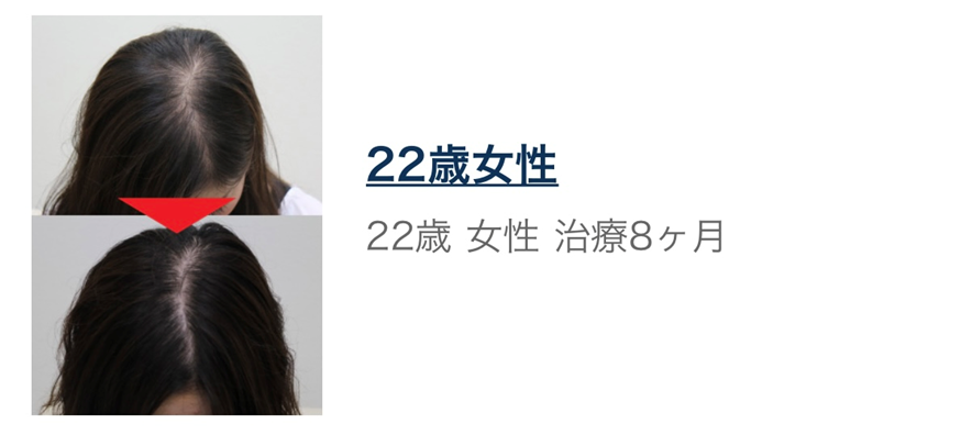 【AGA治療 女性編 後編】
