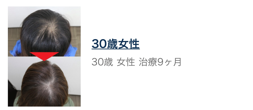 【AGA治療 女性編 後編】