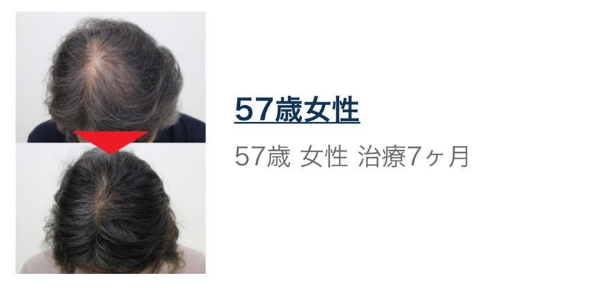 【AGA治療 女性編 後編】