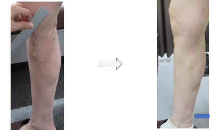 【Varicose Vein treatment Thermal ablation】