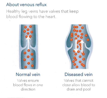 Why do you get varicose vein?