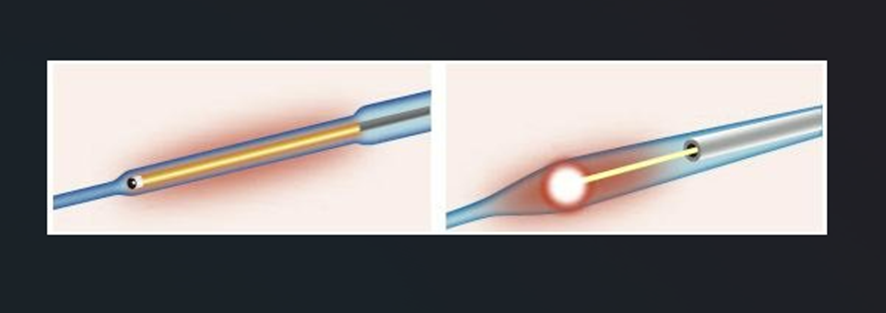 【Varicose Vein treatment Thermal ablation】