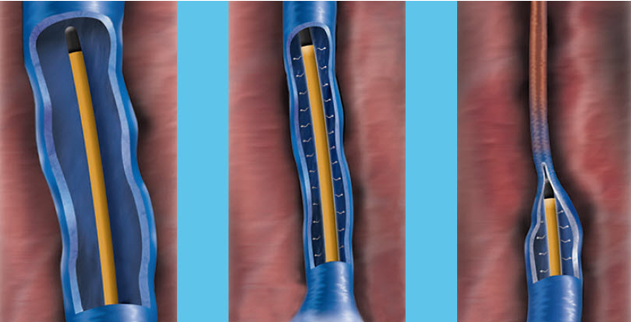 【Varicose Vein treatment Thermal ablation】