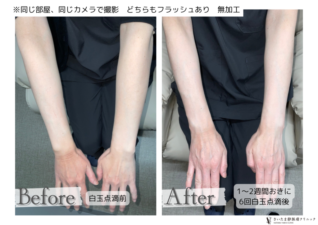 【実例紹介】白玉点滴・にんにく注射　のお知らせ【美容点滴】