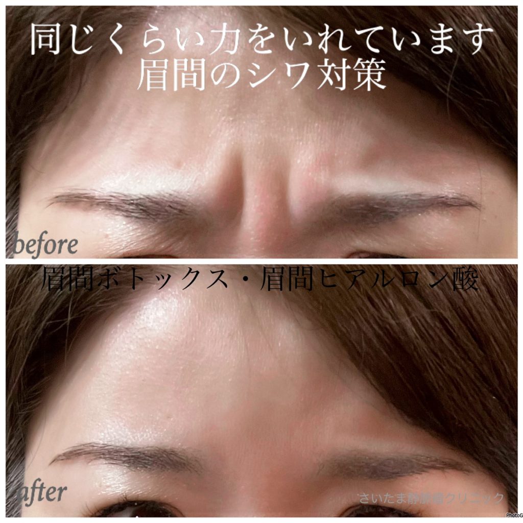 【ボトックス注射とは？　どのような人にお勧め？】