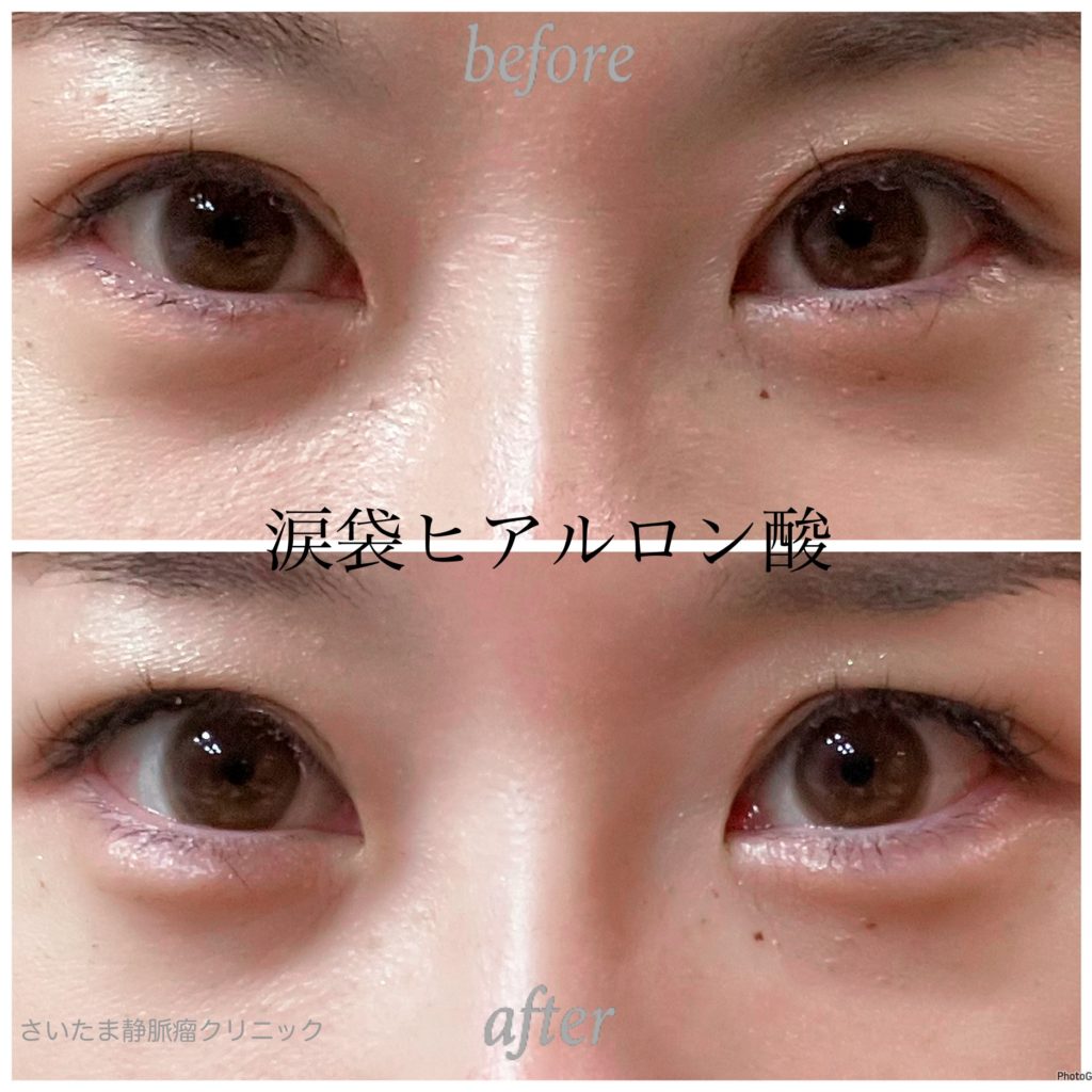 【ヒアルロン酸とは？　ヒアルロン酸注射について】