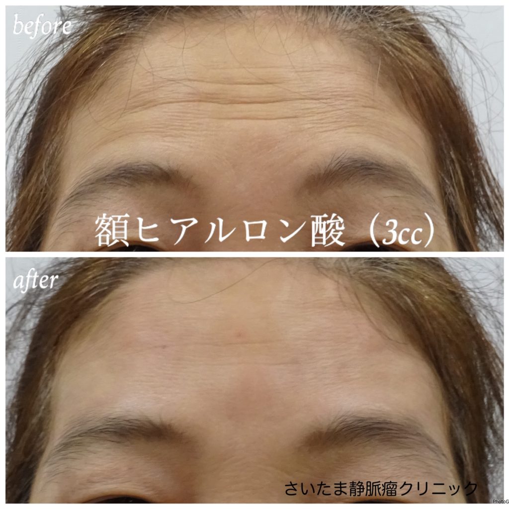 【ヒアルロン酸とは？　ヒアルロン酸注射について】
