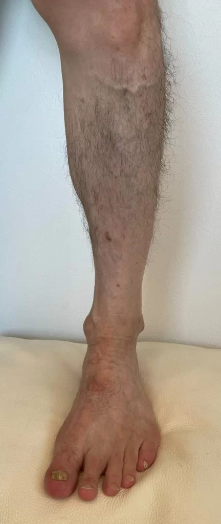 【足の血管が浮き出る理由は？予防方法や治療方法を解説】