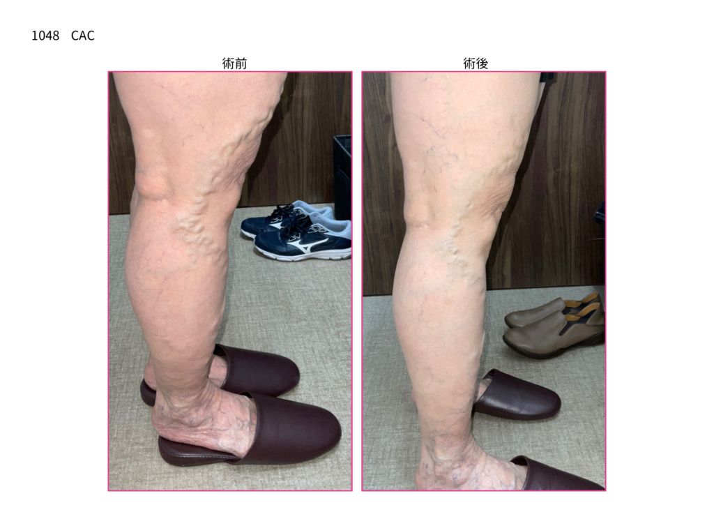 下肢静脈瘤の手術　症例写真の紹介