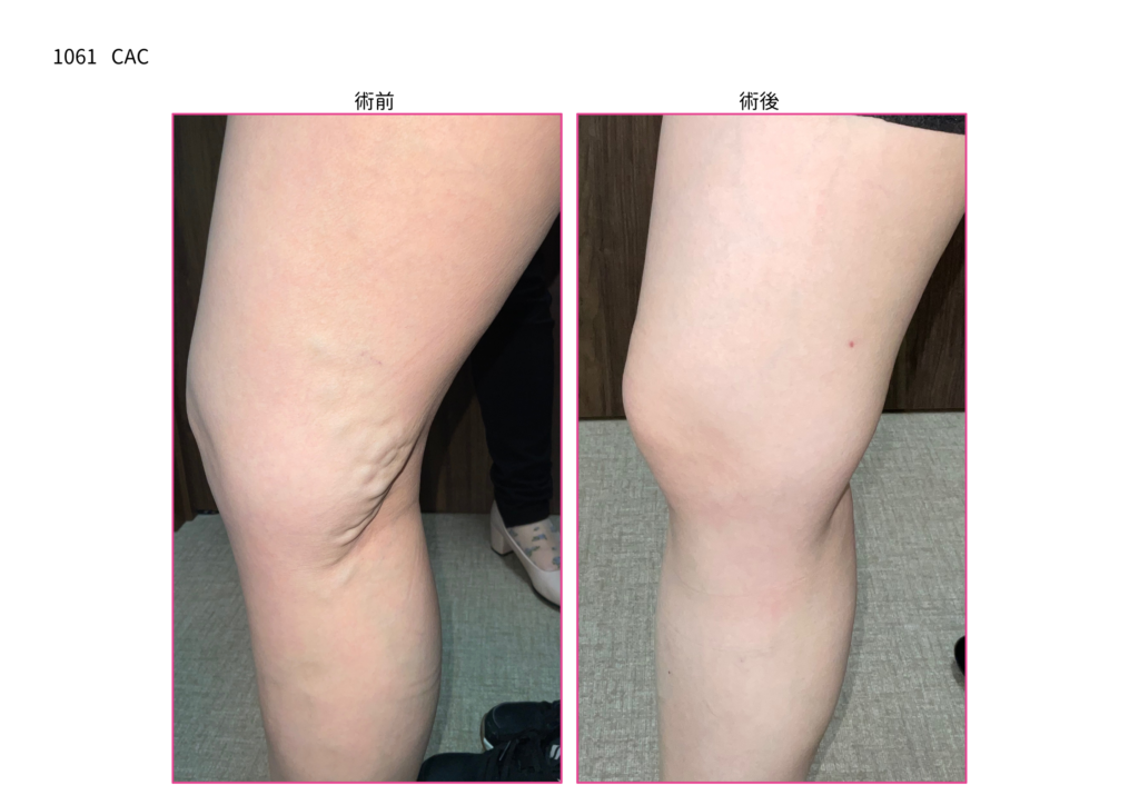 下肢静脈瘤の手術　症例写真の紹介