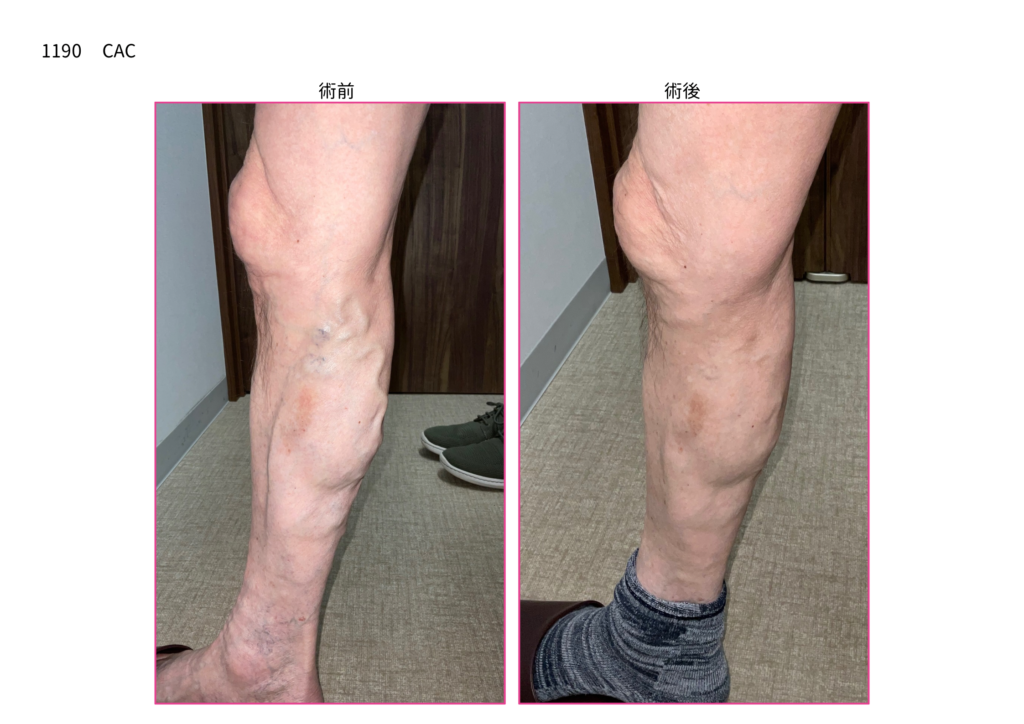 下肢静脈瘤の手術　症例写真の紹介