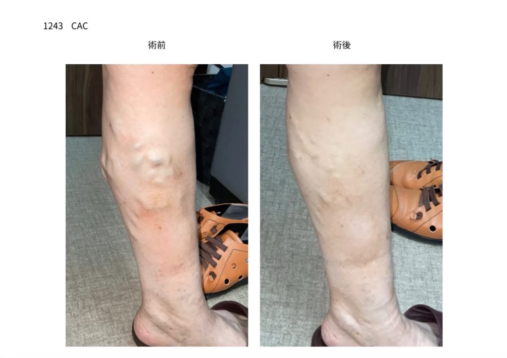 下肢静脈瘤の手術　症例写真の紹介