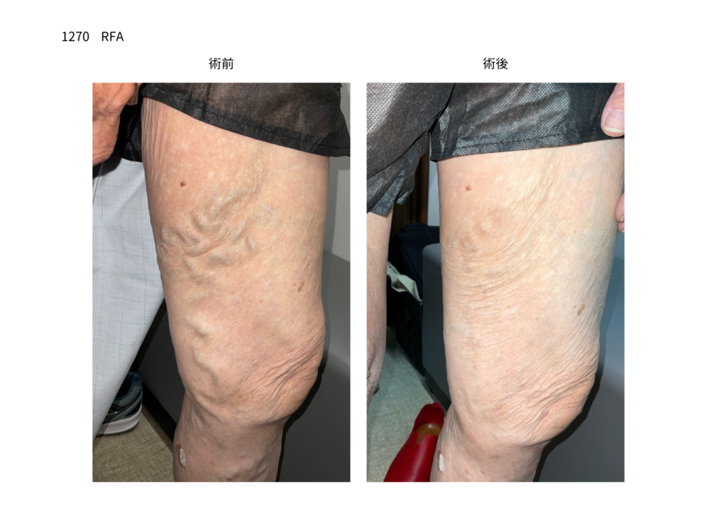 下肢静脈瘤の手術　症例写真の紹介