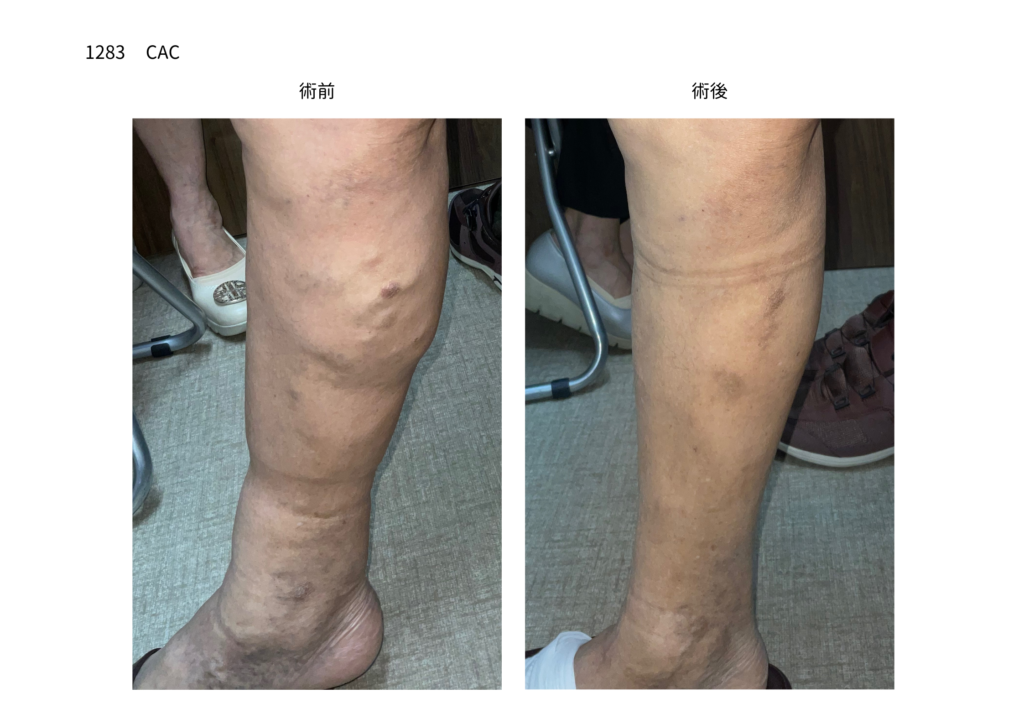 下肢静脈瘤の手術　症例写真の紹介