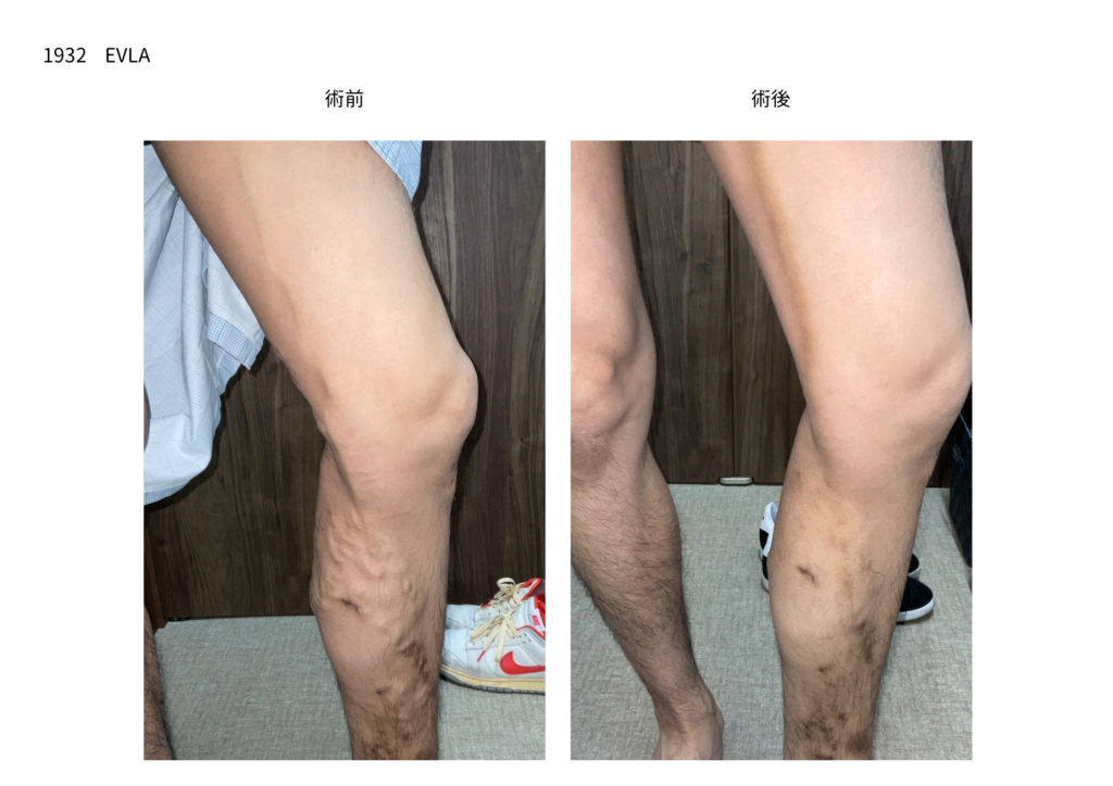 下肢静脈瘤の手術　症例写真の紹介