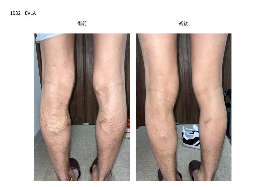 下肢静脈瘤の手術　症例写真の紹介