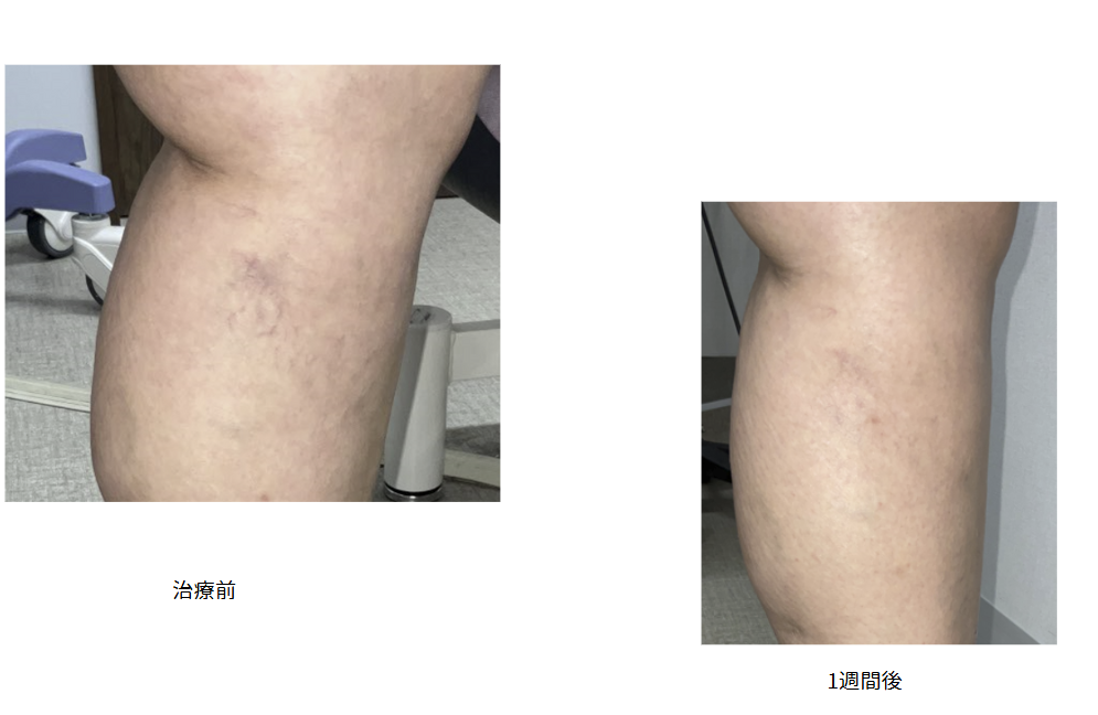 【網の目・クモの巣静脈瘤の治療症例写真の紹介】