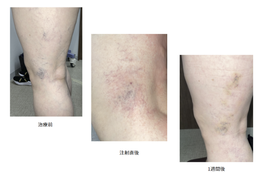 【網の目・クモの巣静脈瘤の治療症例写真の紹介】