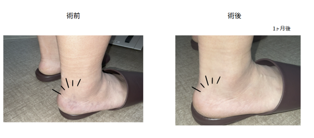 【網の目・クモの巣静脈瘤の治療症例写真の紹介】