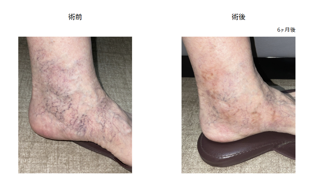 【網の目・クモの巣静脈瘤の治療症例写真の紹介】