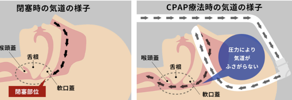 【いびきが多い人は要注意!? 睡眠時無呼吸症候群について解説!】 3 【いびきが多い人は要注意!? 睡眠時無呼吸症候群について解説!】